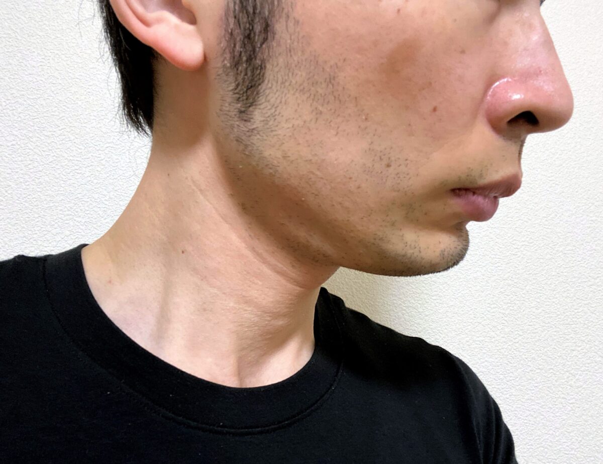 脱毛後に再び生えた頬ヒゲ