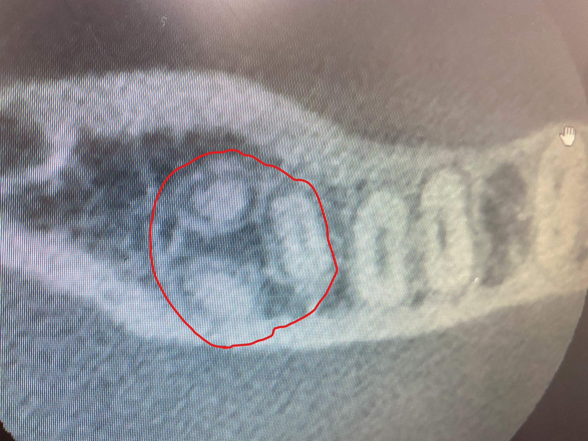 親知らず抜歯CT