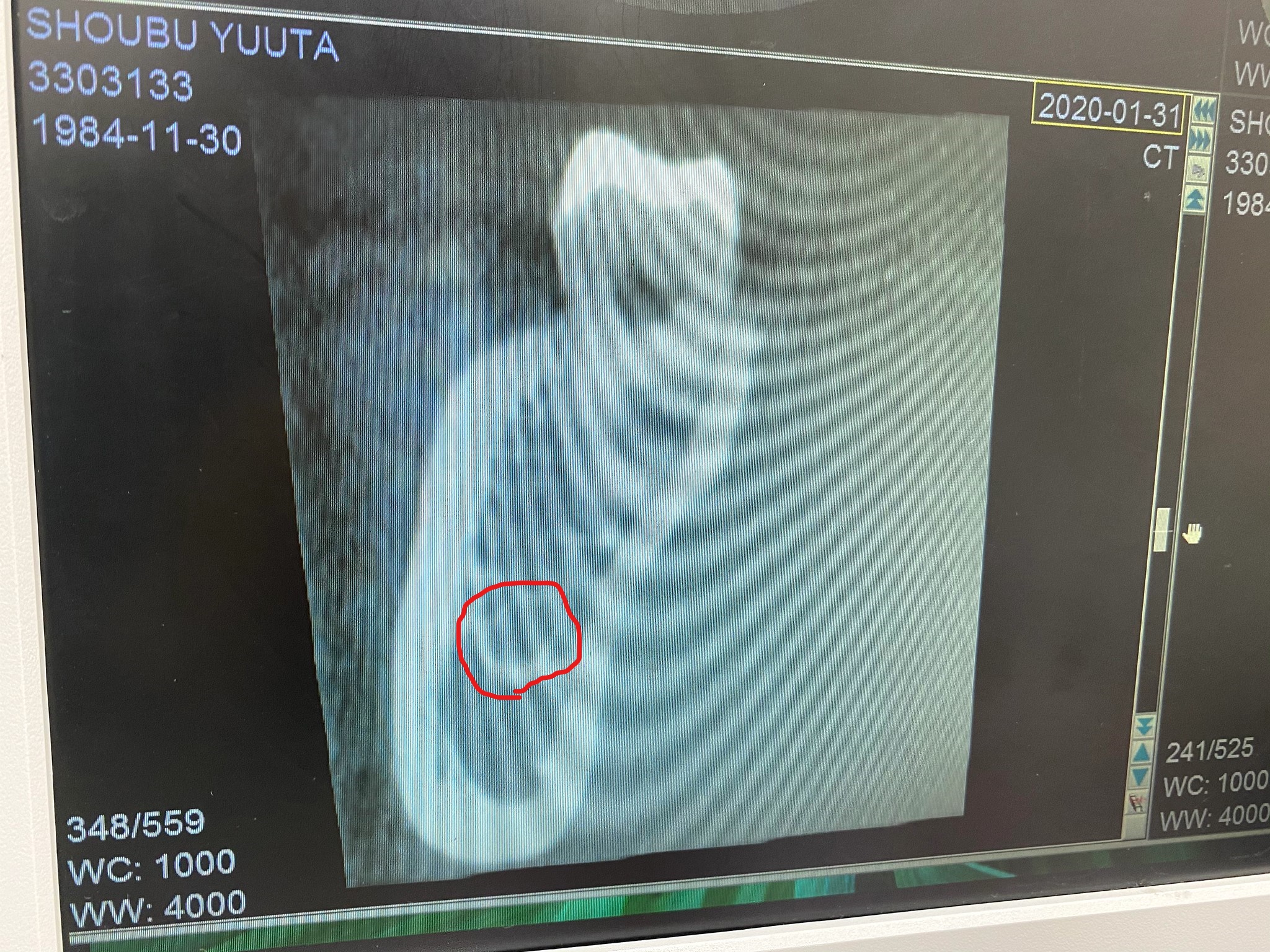 親知らず抜歯CT