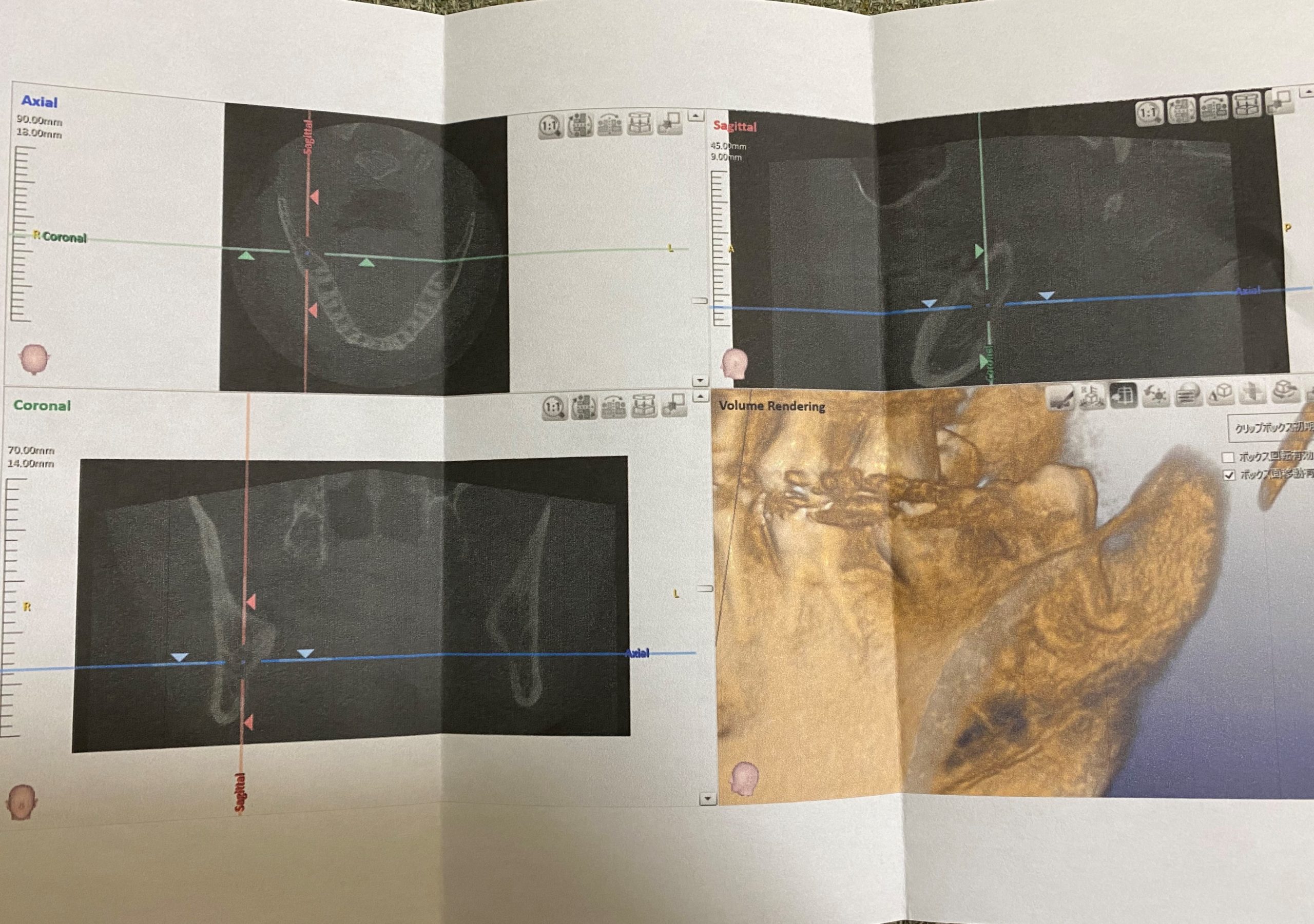親知らず抜歯紹介状