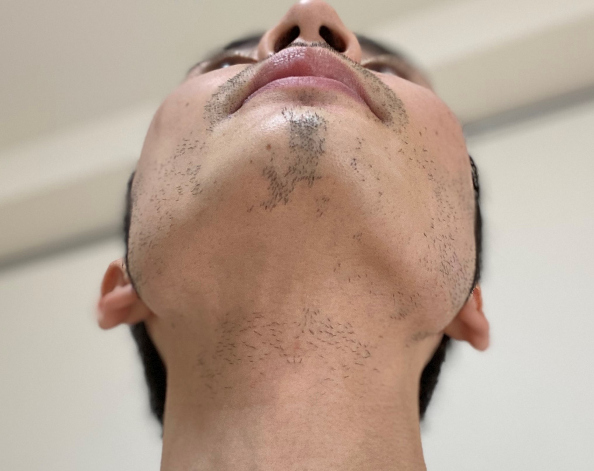 ヒゲ脱毛14回目の効果