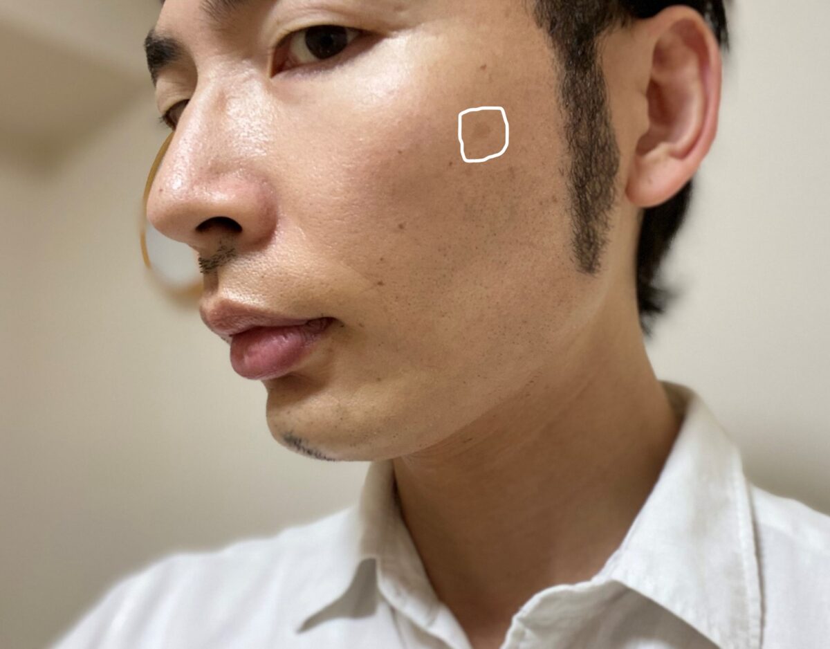画像 30代男がシミ取りレーザーの効果 経過を報告 1カ月後 医療ライター庄部勇太の取材ノート