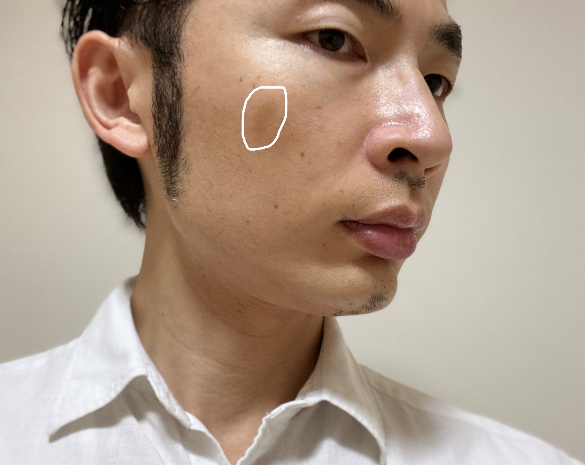 シミ取り治療前