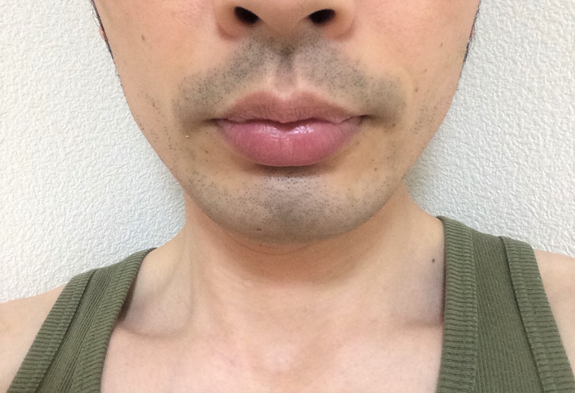 ヒゲ脱毛後の泥棒ヒゲ