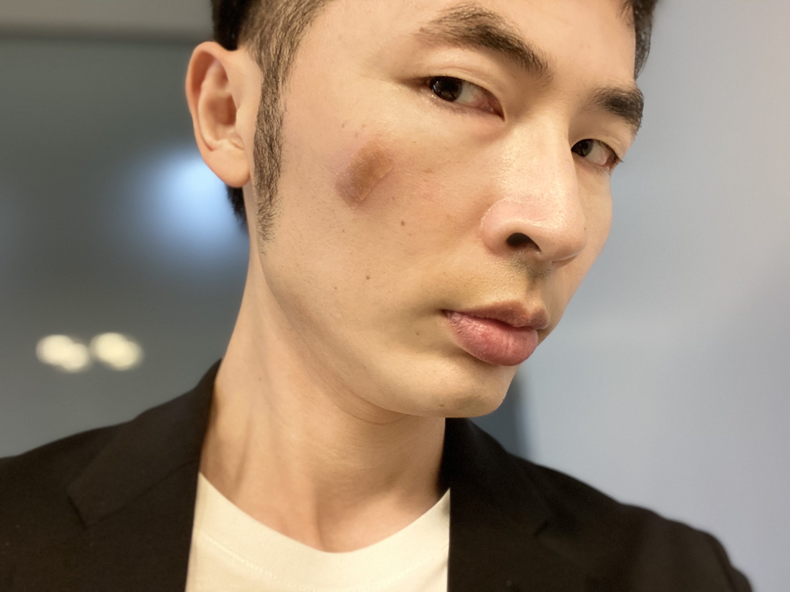 男のシミ取りレーザー治療
