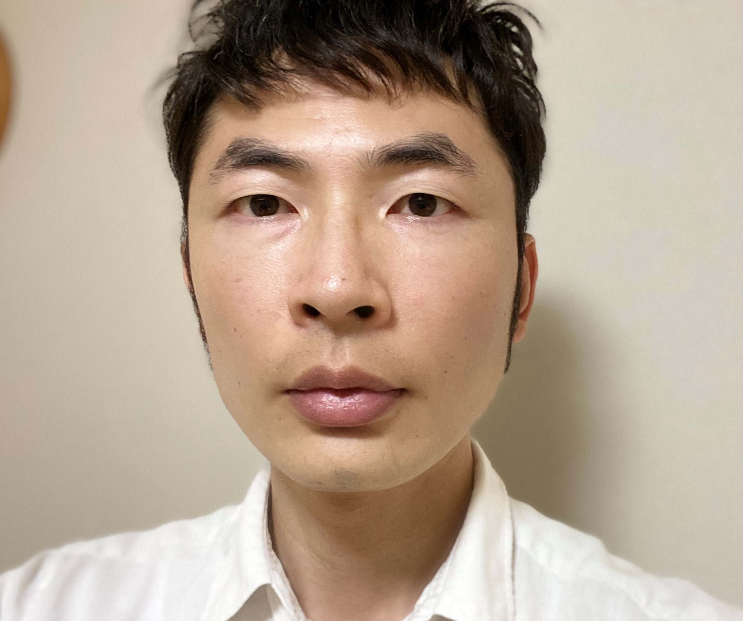 シミ取り治療1カ月後