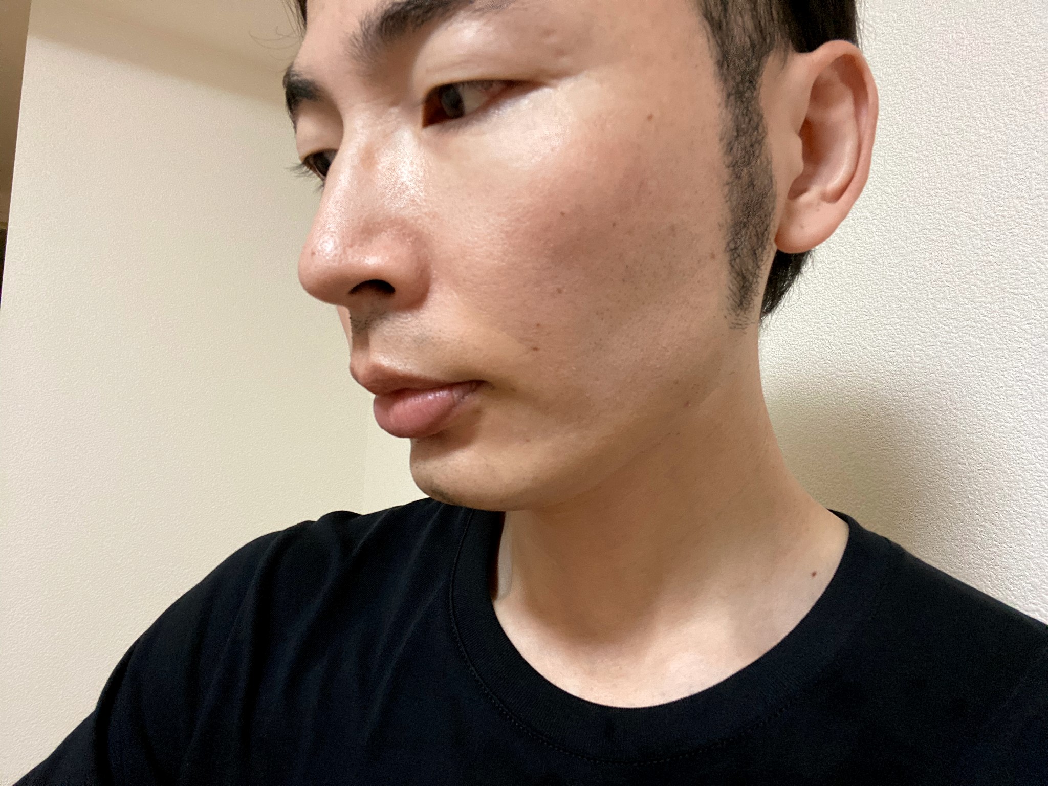 シミ取りレーザー治療