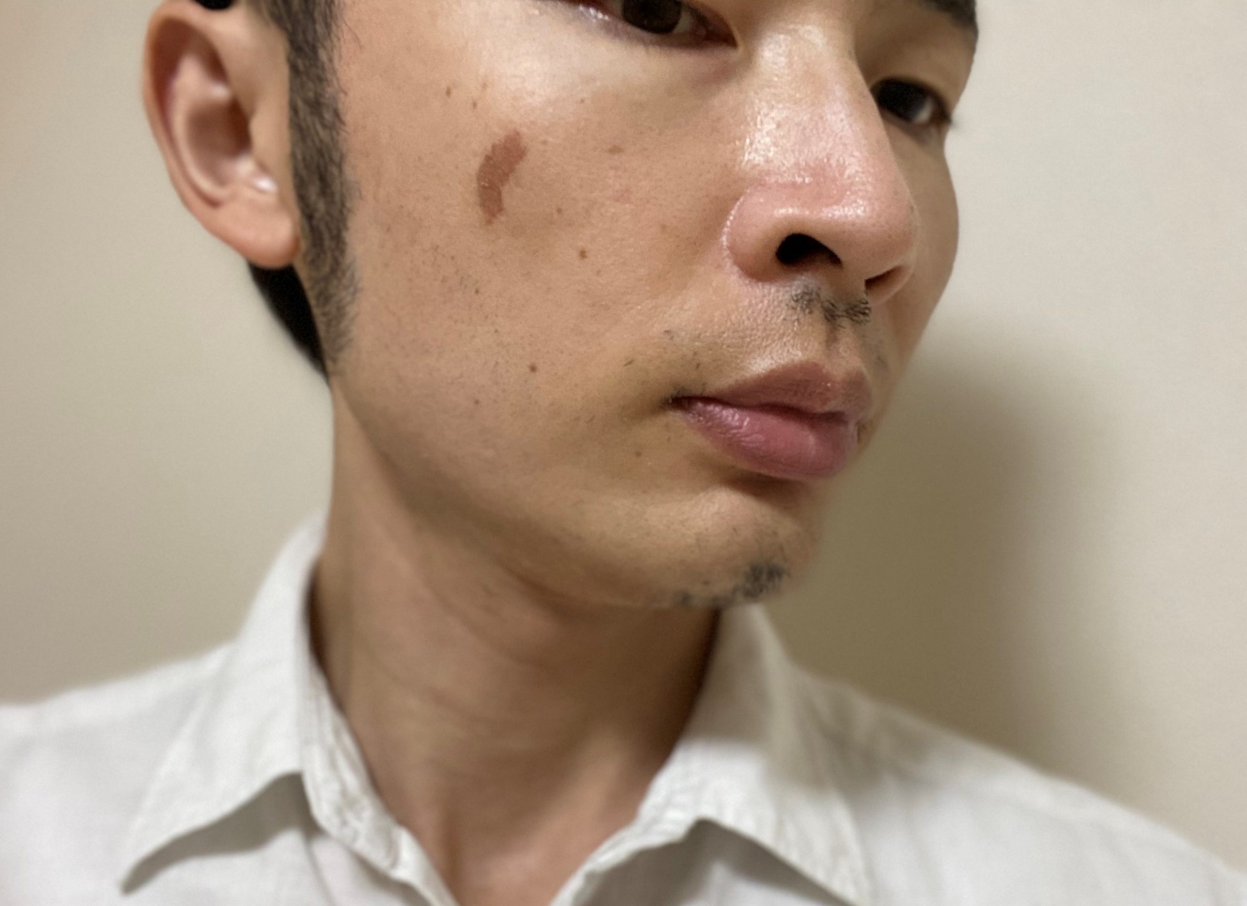 シミ取りレーザー治療
