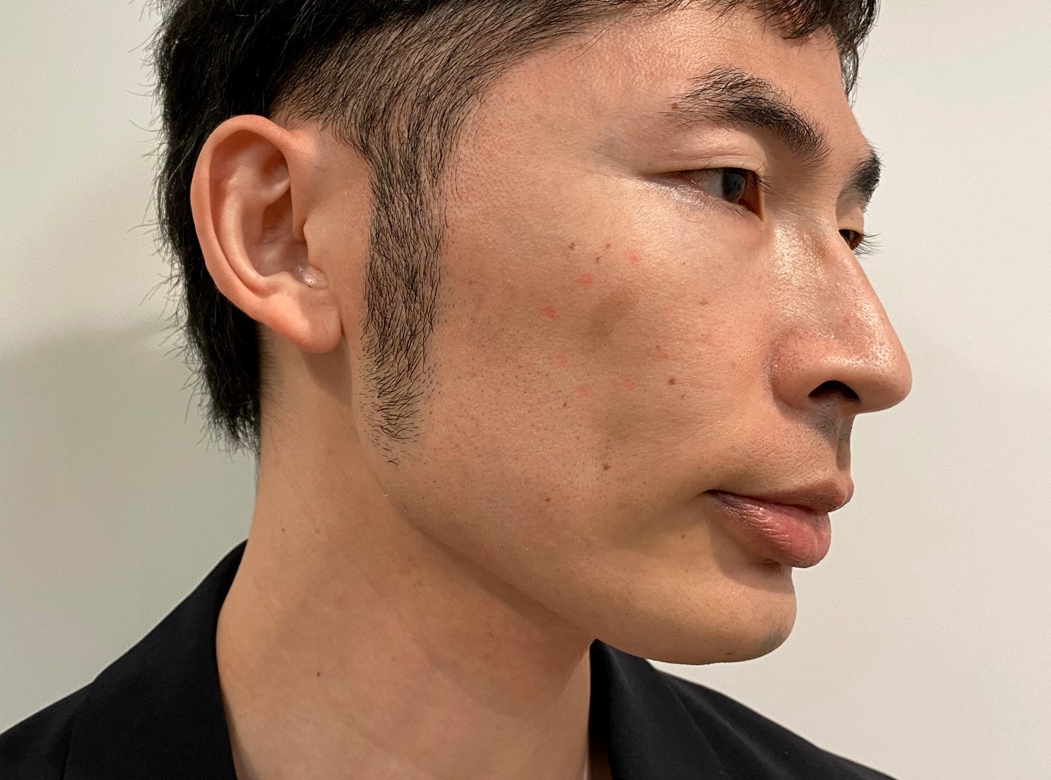 男のシミ取りレーザー治療