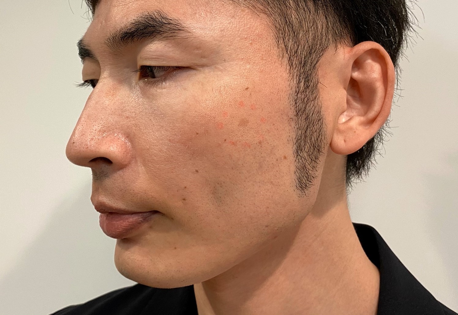 男のシミ取りレーザー治療