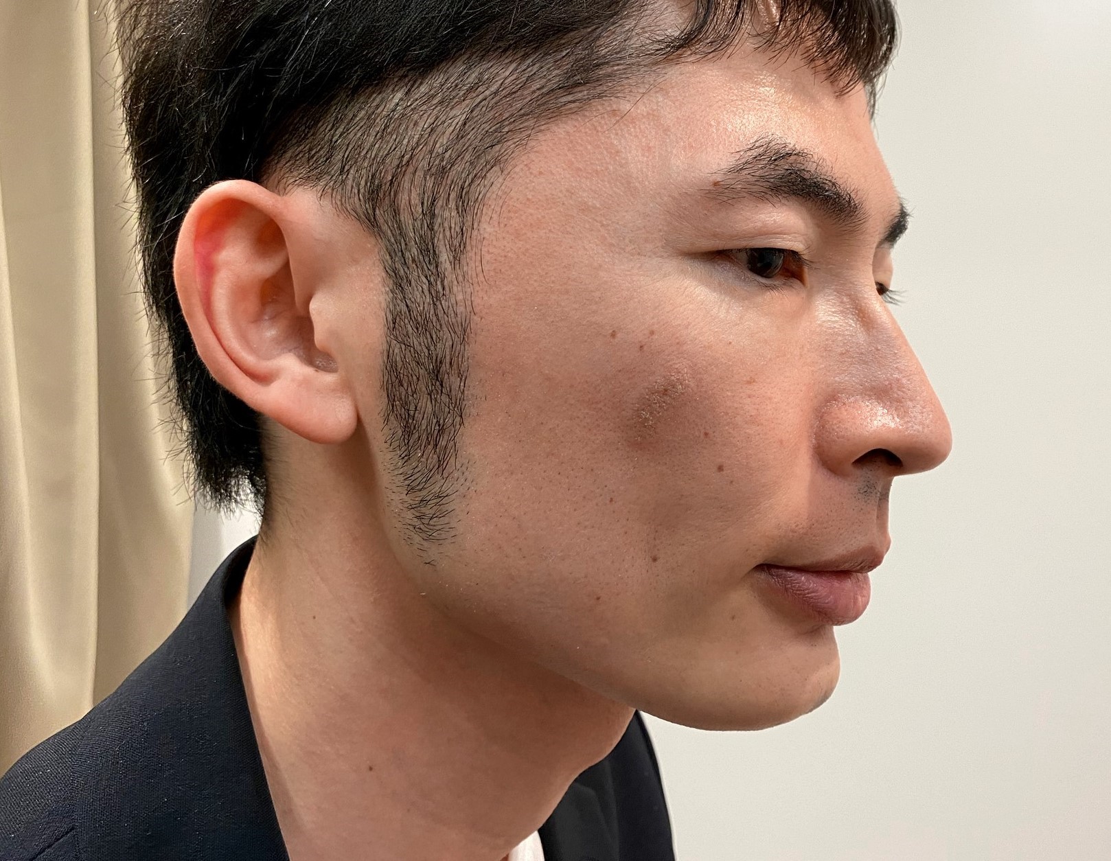 男のシミ取りレーザー治療