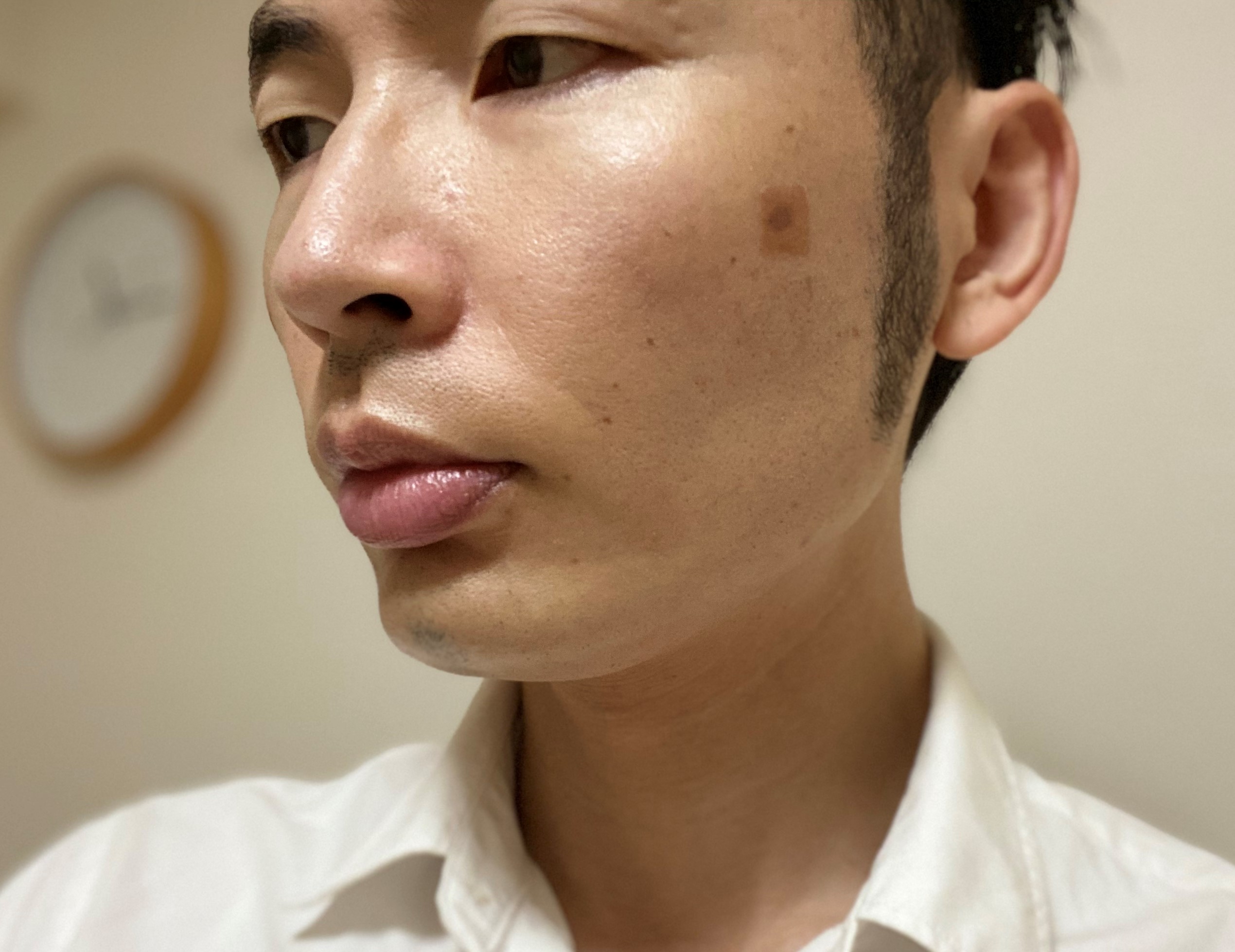 シミ取りレーザー治療