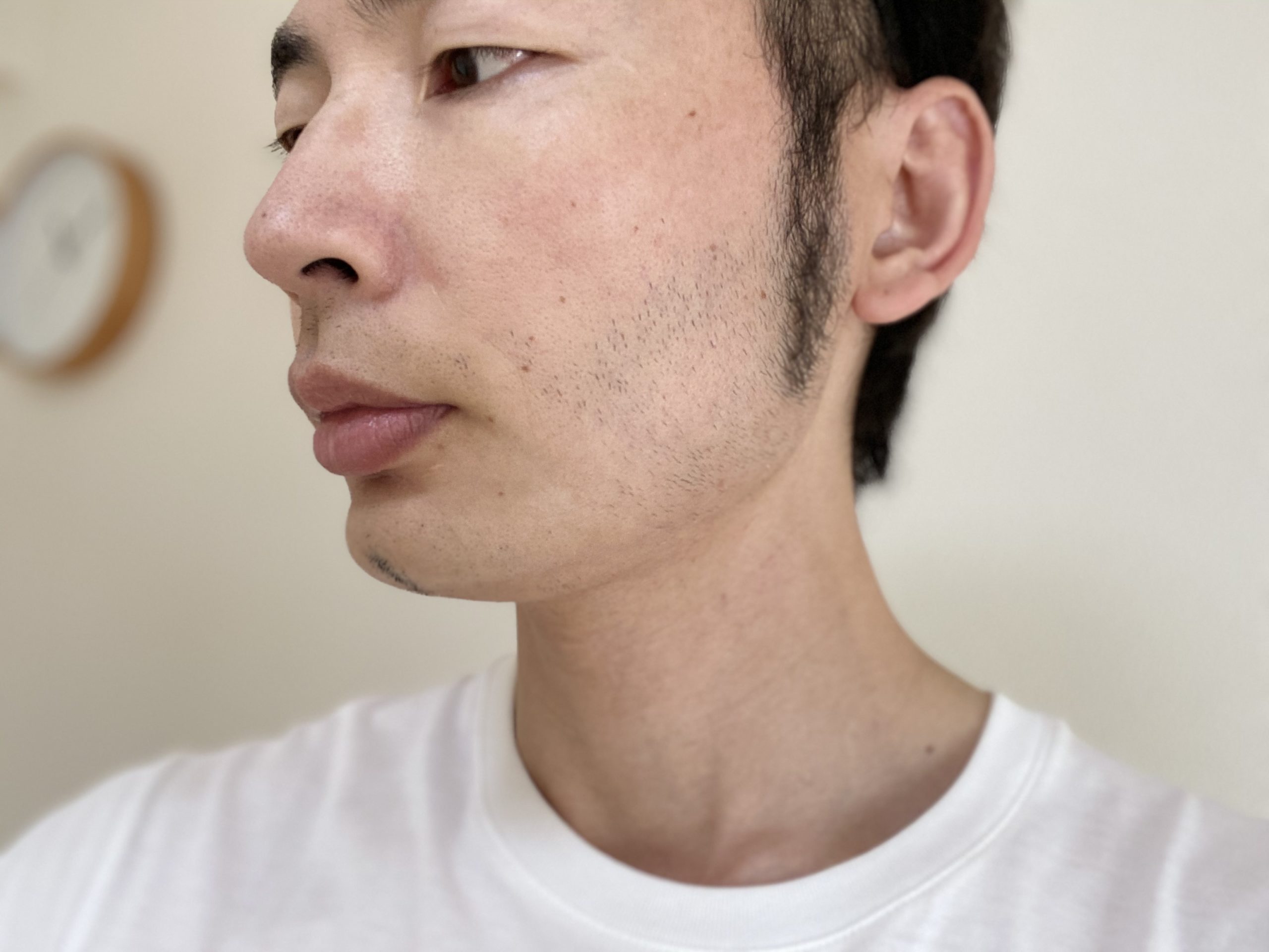 頬ヒゲ脱毛7回目の効果