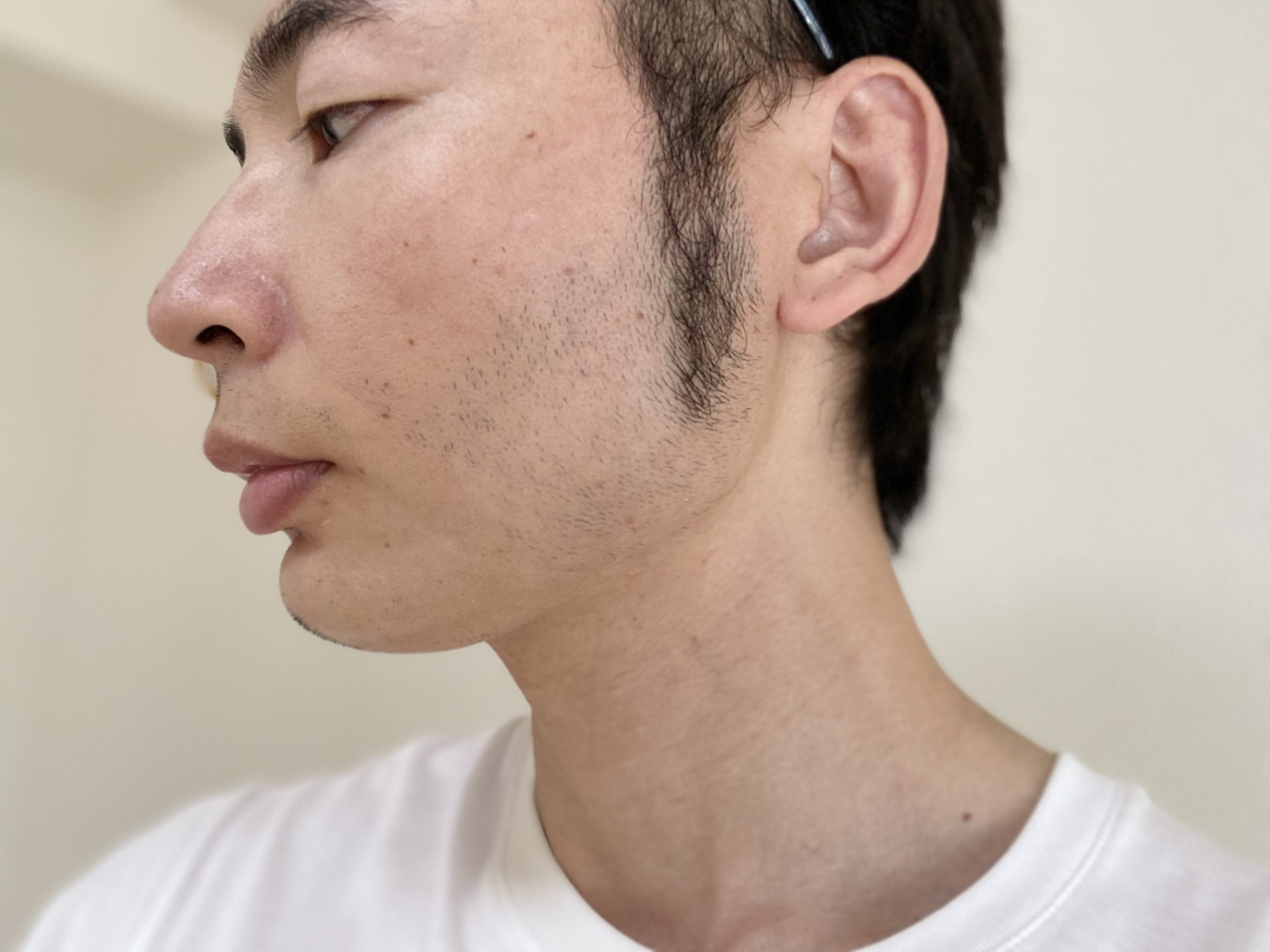 頬ヒゲ脱毛7回目の効果