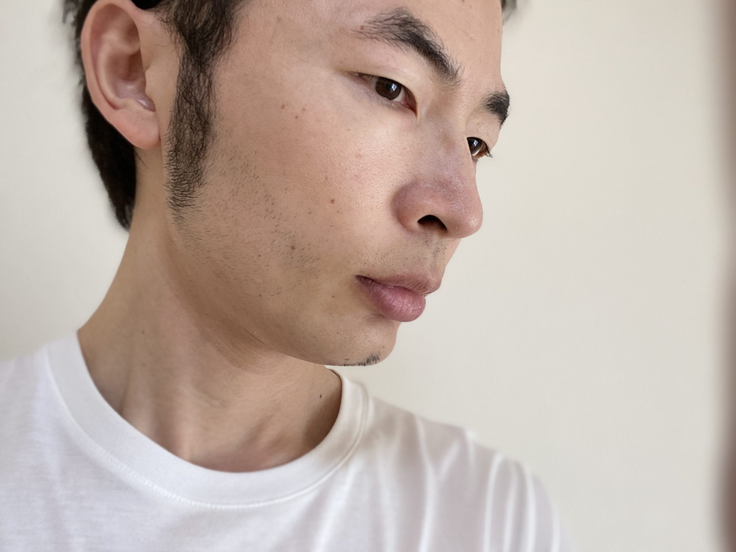 頬ヒゲ脱毛7回目の効果