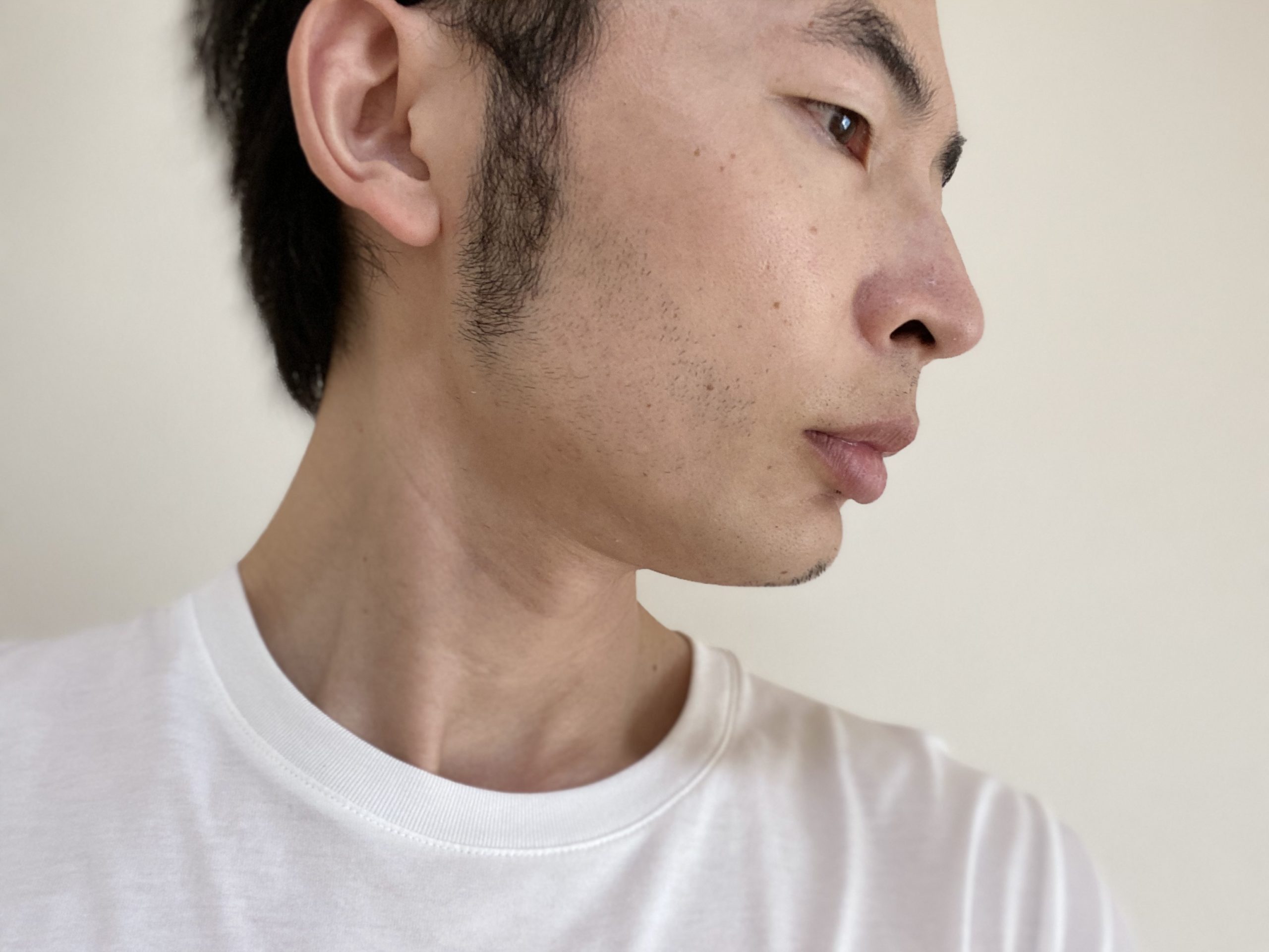 頬ヒゲ脱毛7回目の効果