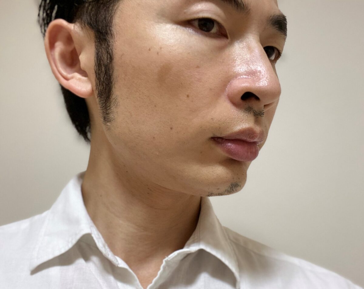頬ヒゲ脱毛7回目1カ月後右