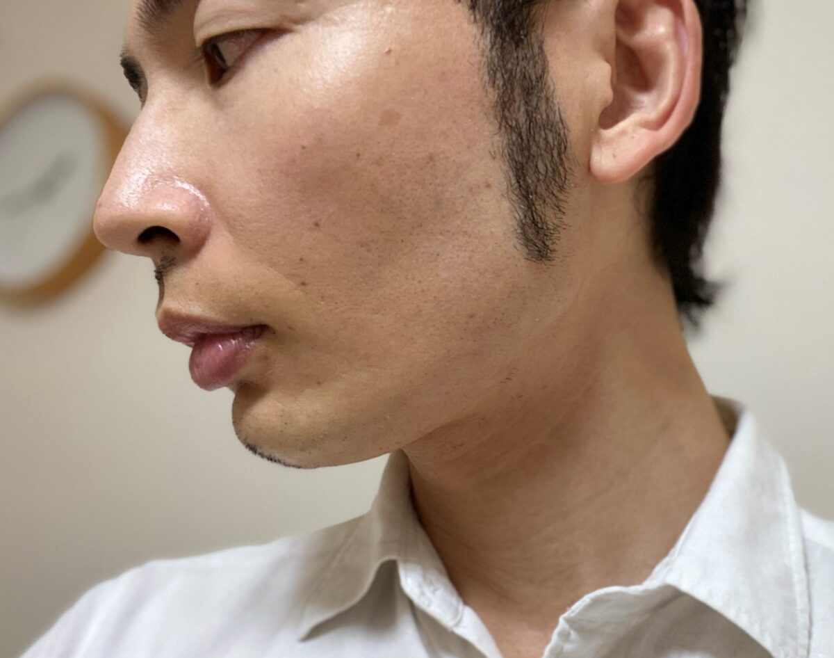 頬ヒゲ脱毛7回目1カ月後左