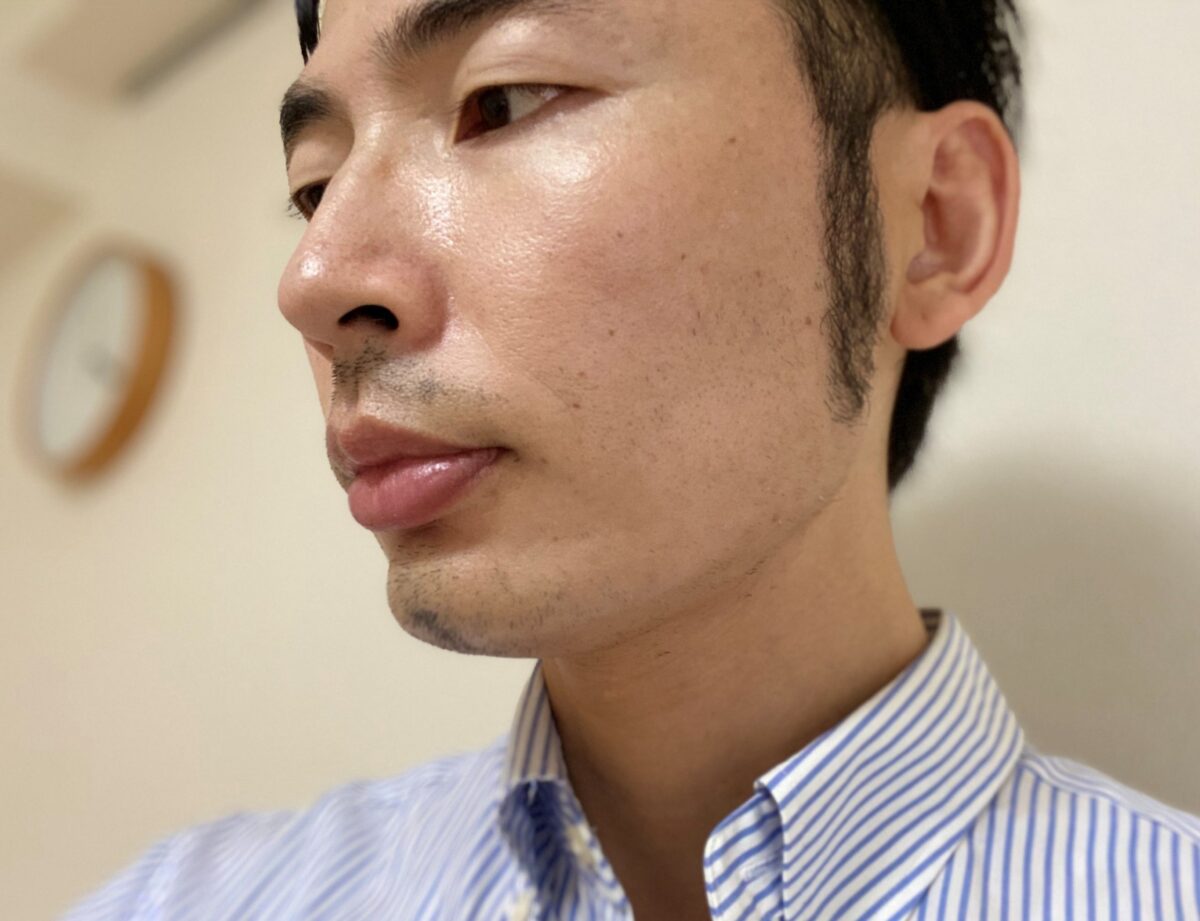 頬ヒゲ脱毛7回目2カ月後左