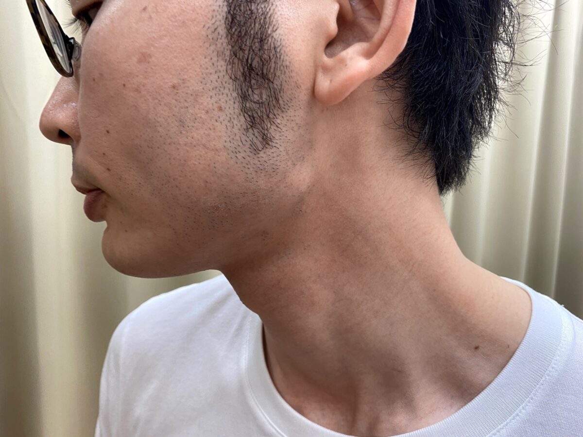 ヒゲ脱毛7回目施術前左