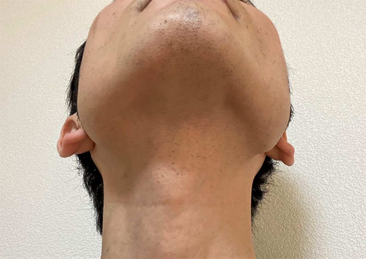 首ヒゲ脱毛1回目効果