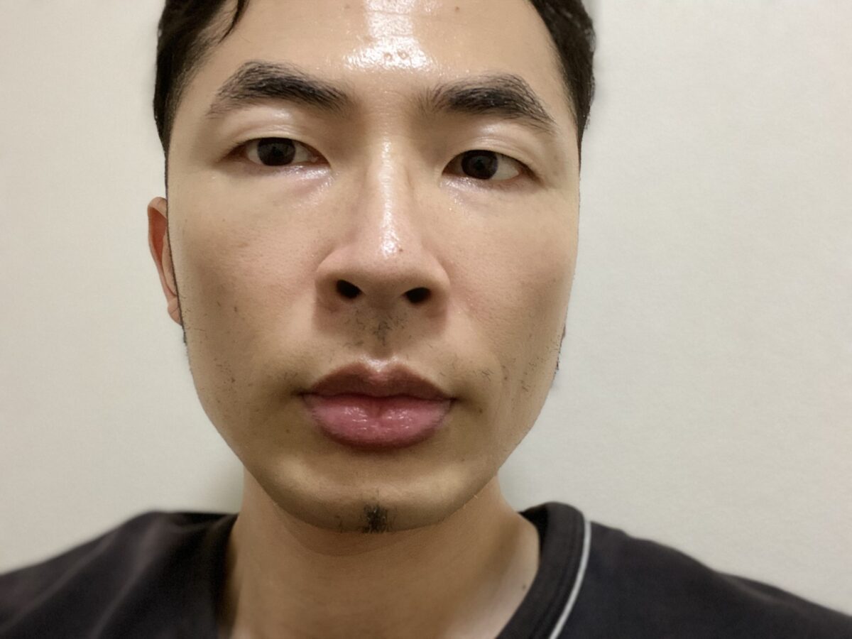 画像 小鼻と眉間の赤みを塗り薬で治した体験談 脂漏性皮膚炎 医療ライター庄部勇太の取材ノート