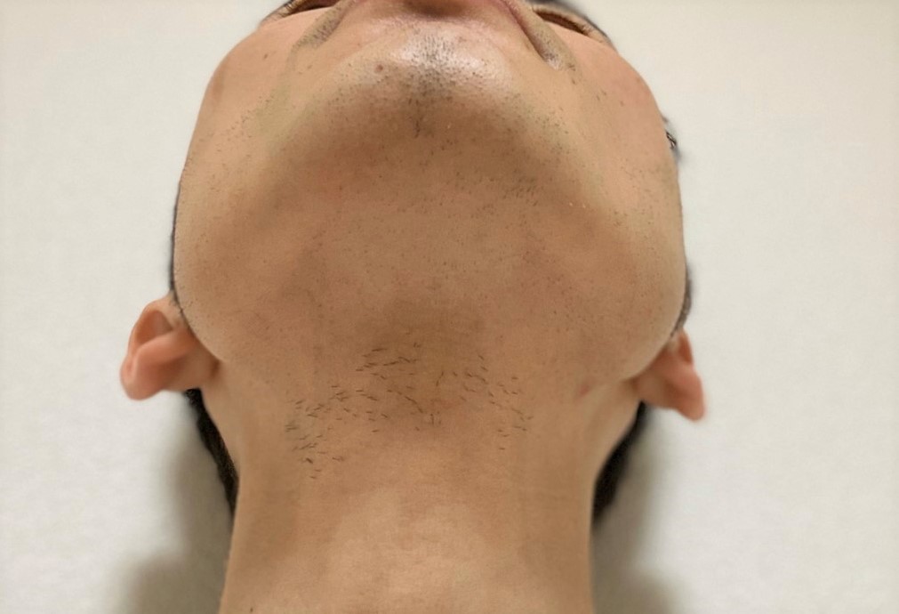 首ヒゲ脱毛開始前
