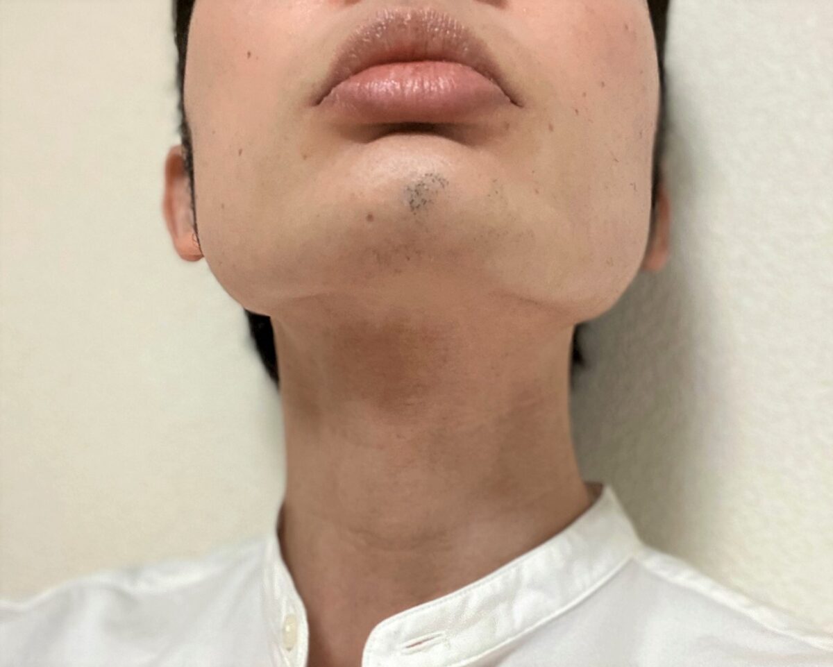 湘南美容クリニックでのヒゲ脱毛17回目の効果