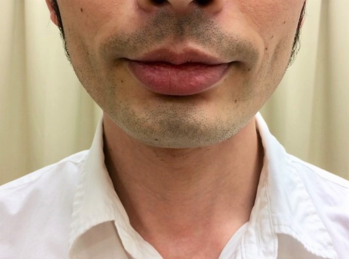 ヒゲ脱毛を始める前のヒゲ