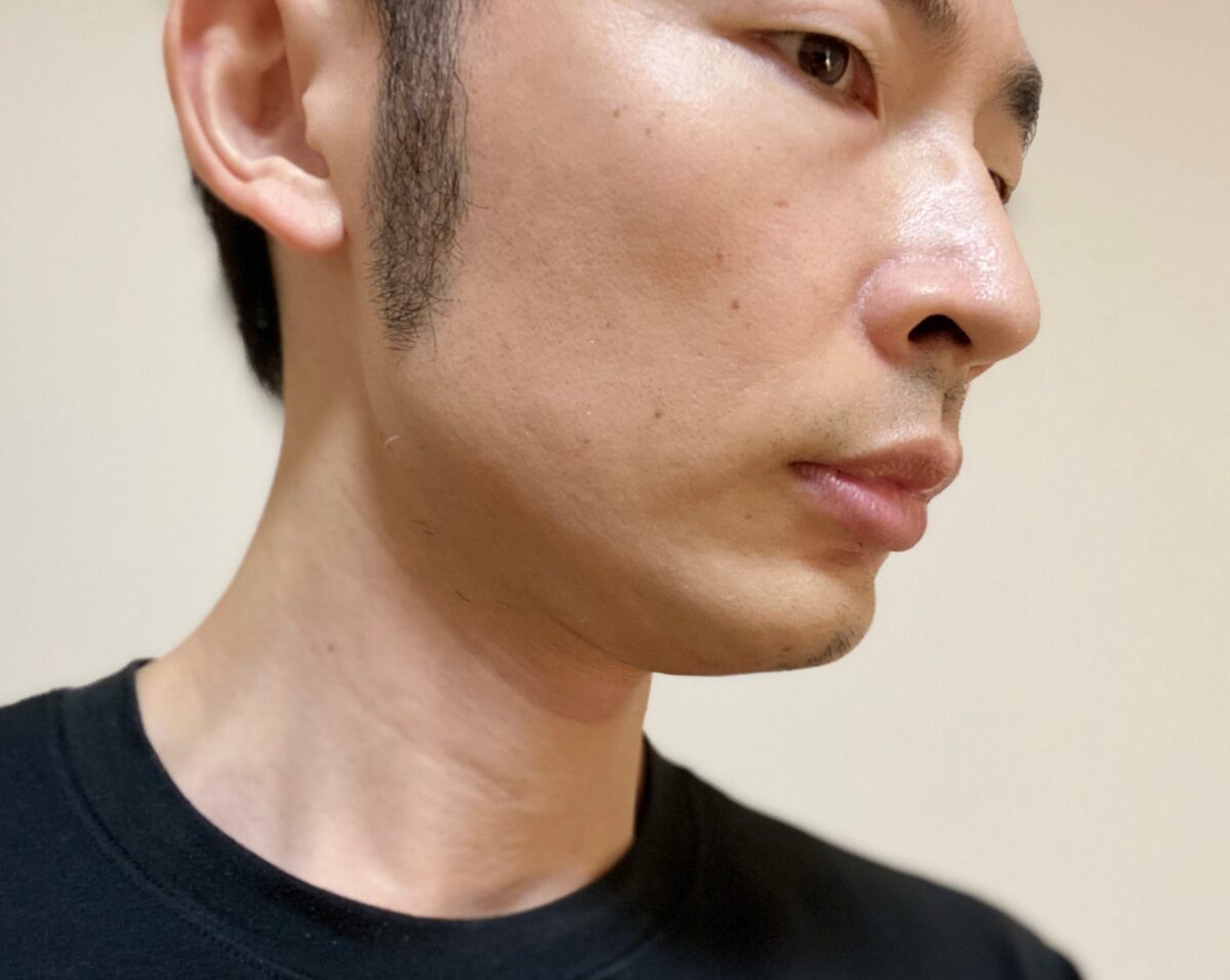 頬ヒゲ脱毛8回目の効果