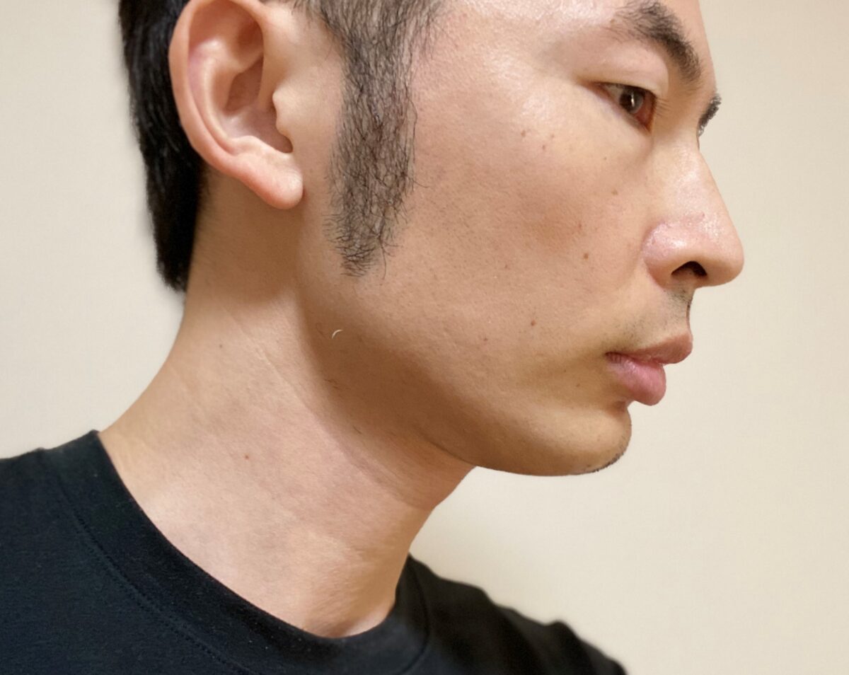 頬ヒゲ脱毛8回目の効果