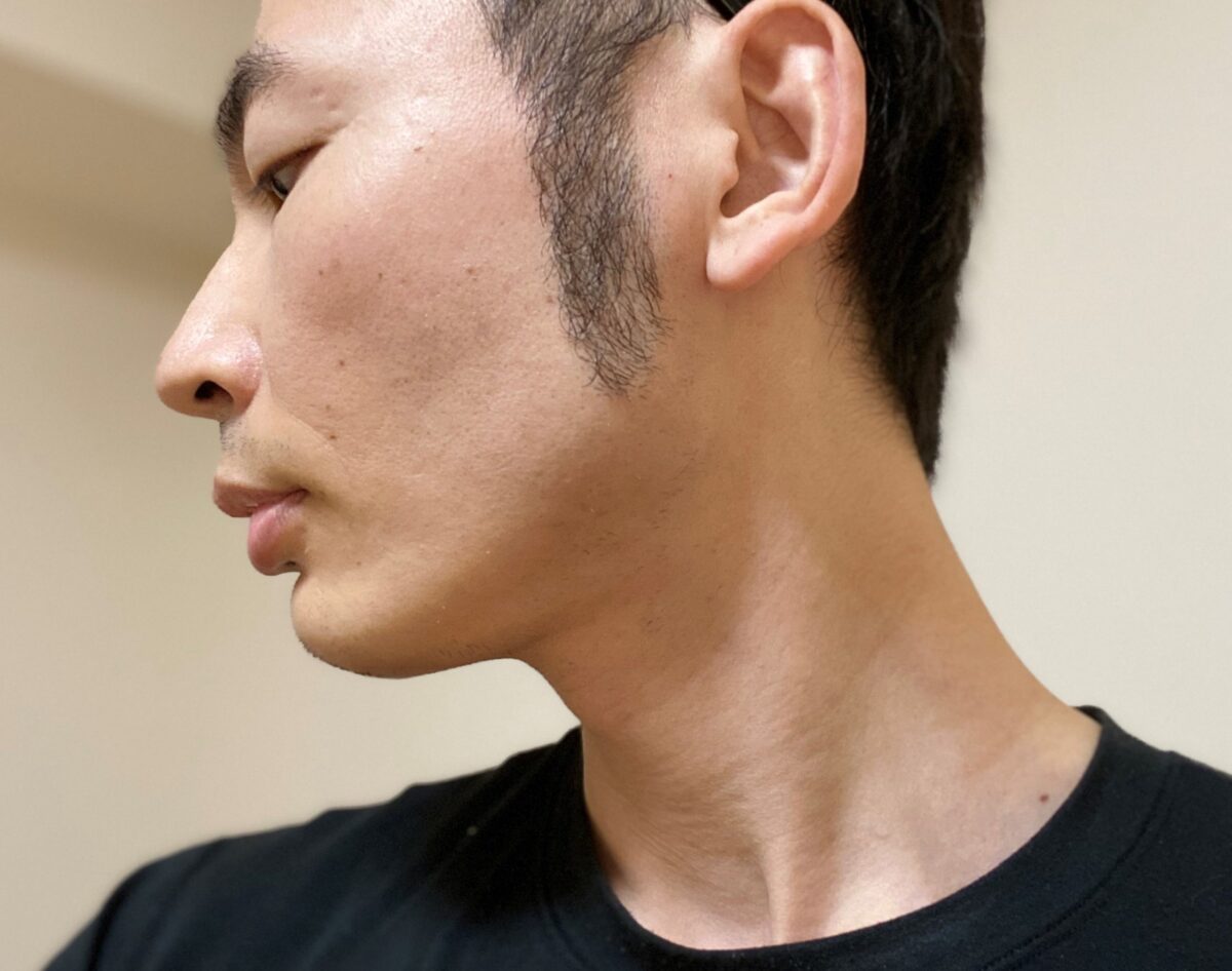 頬ヒゲ脱毛8回目の効果