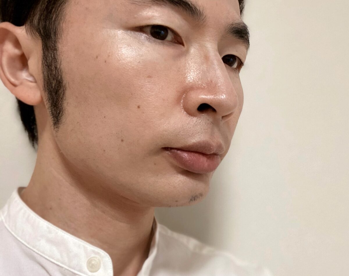 頬ヒゲ脱毛8回目の効果