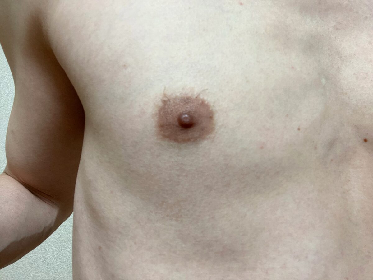 男の胸毛脱毛1回目の効果