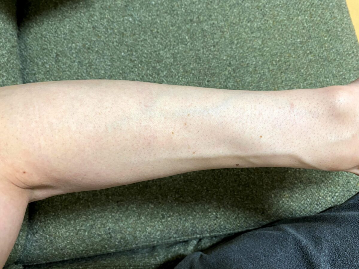 男の腕脱毛1回目の効果