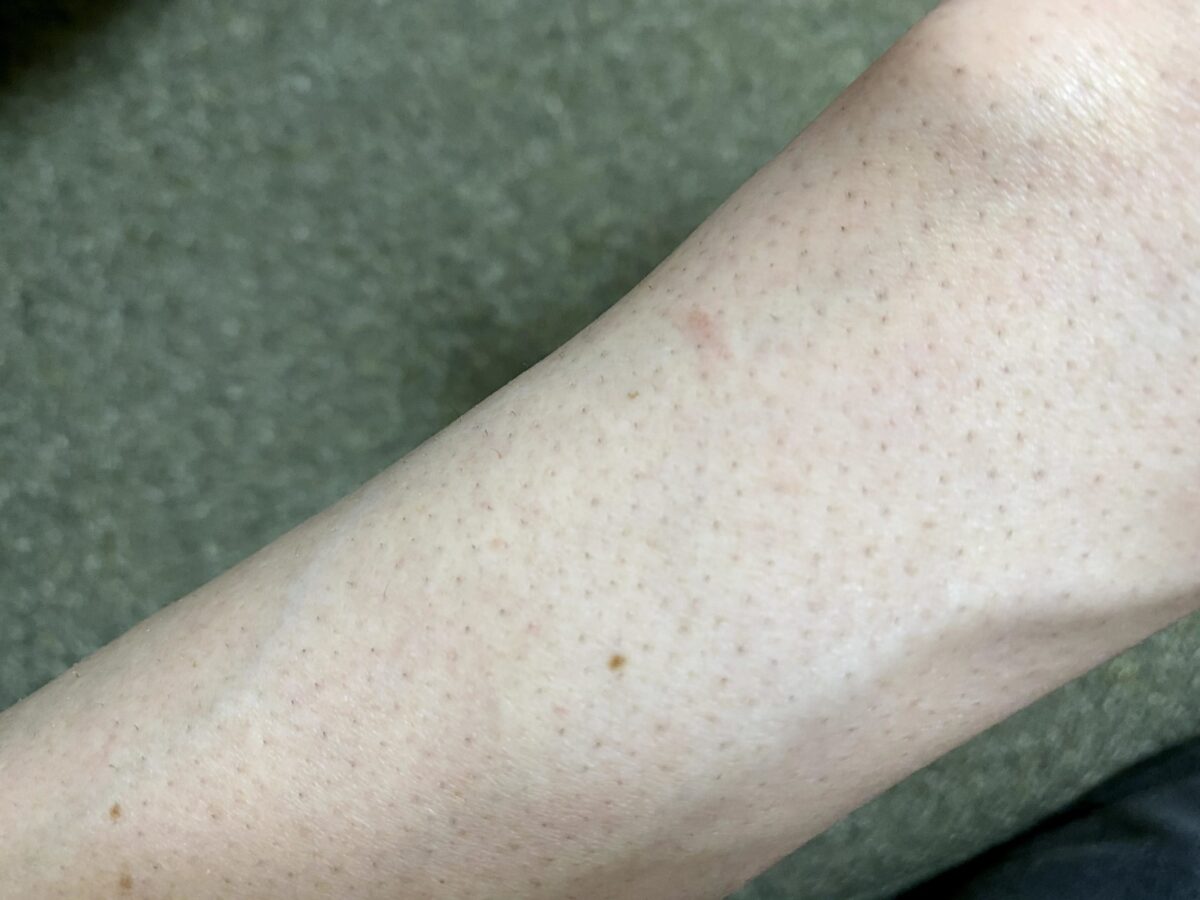 男の腕脱毛1回目の効果