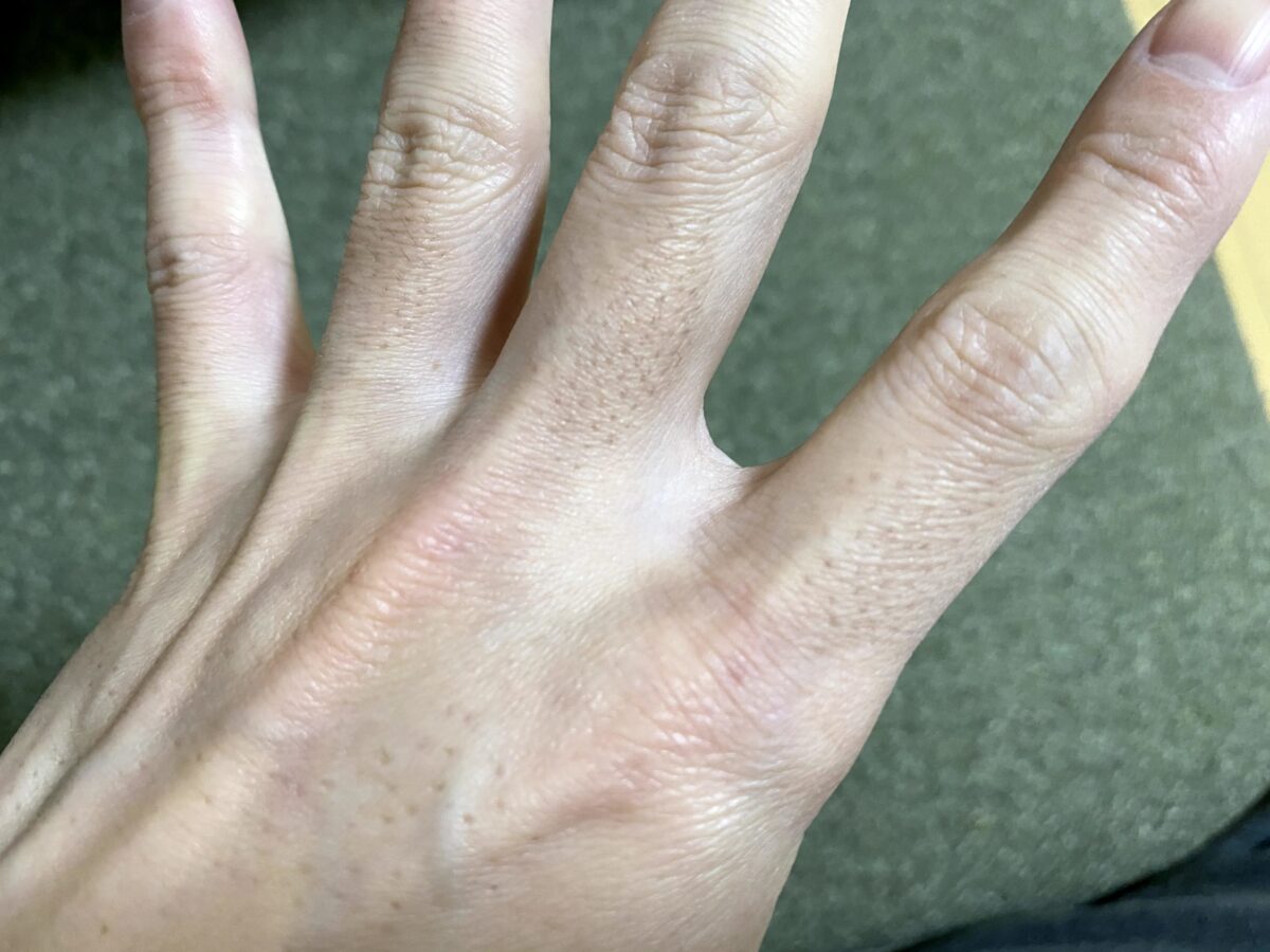 男の腕脱毛1回目の効果