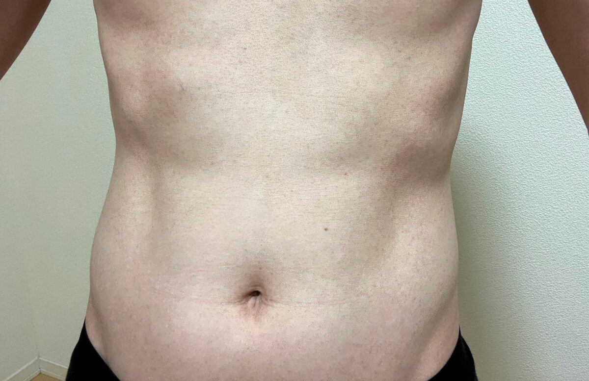男の腹毛脱毛1回目の効果