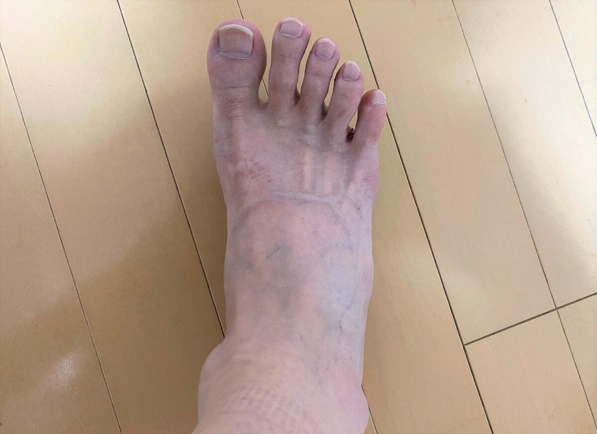 男の脚脱毛1回目の効果