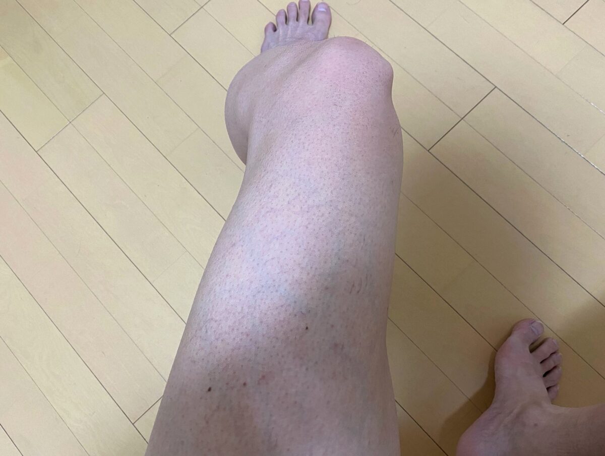 男の脚脱毛1カ月後