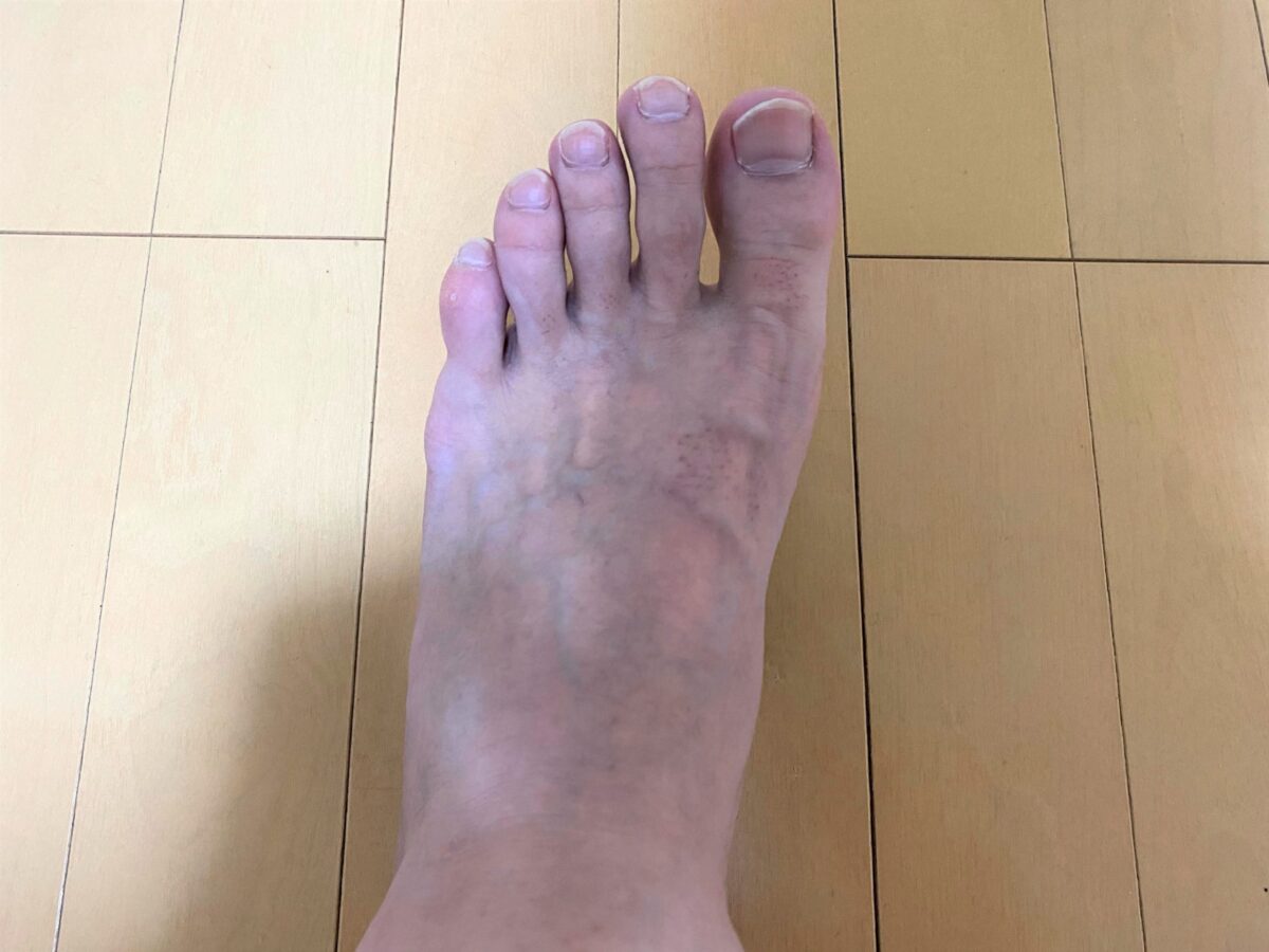 男の脚脱毛1回目の効果