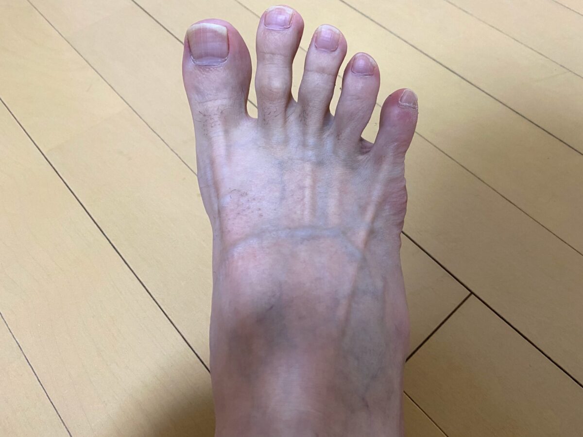 男の全身脱毛1回目2カ月後の脚