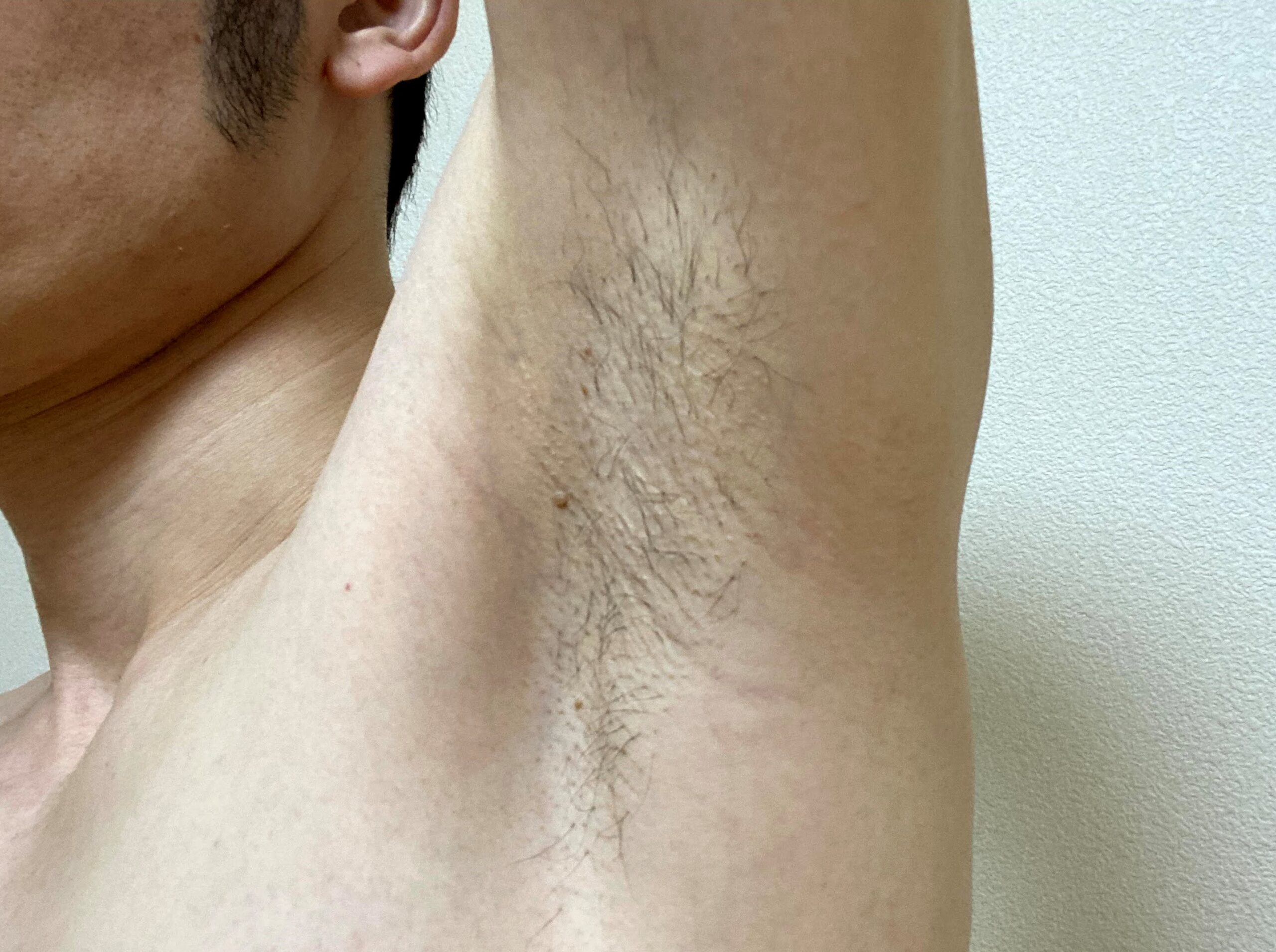 メンズわき脱毛の感想