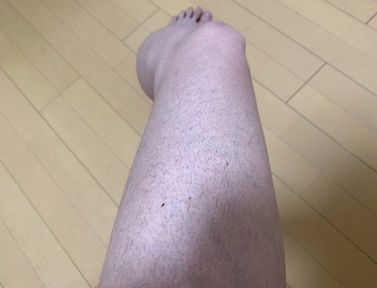 男の全身脱毛1回目2カ月後の脚