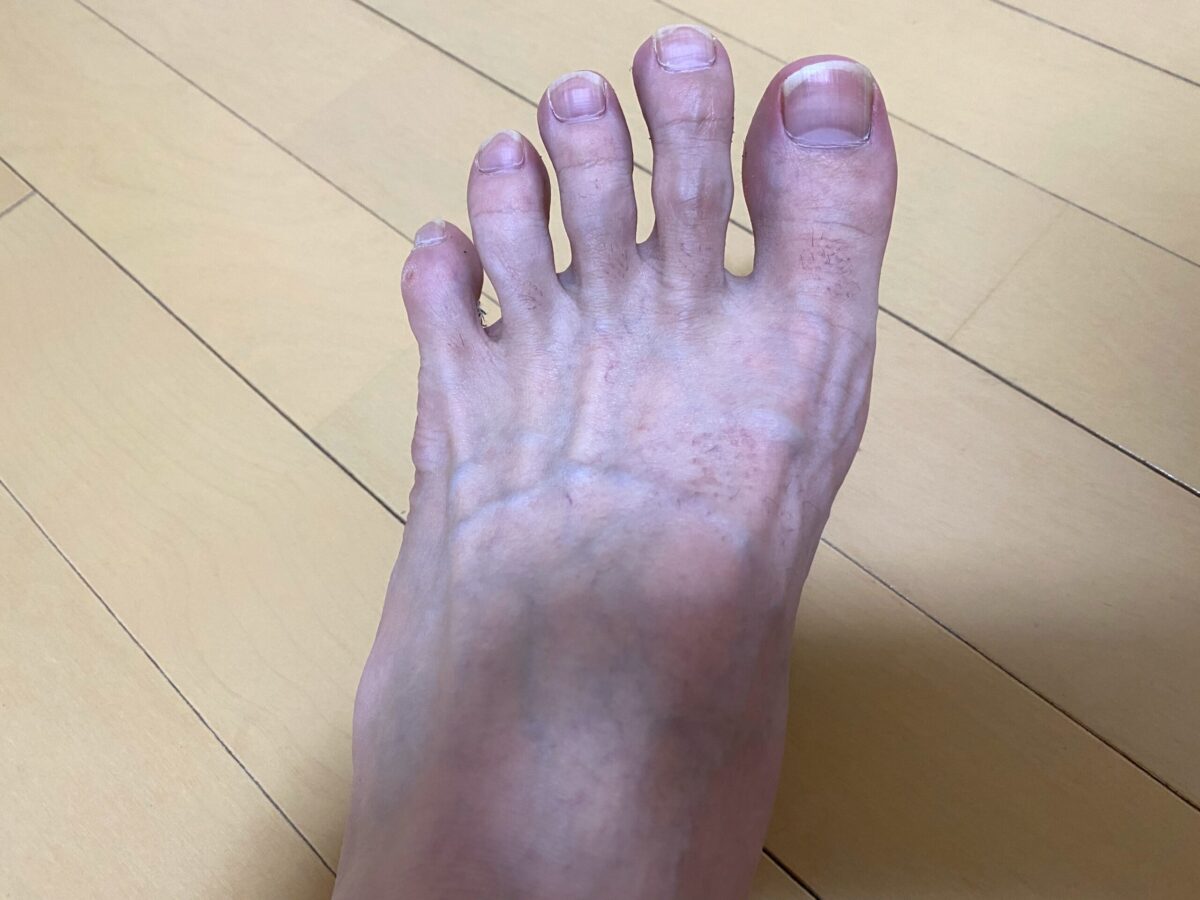 男の全身脱毛1回目2カ月後の脚