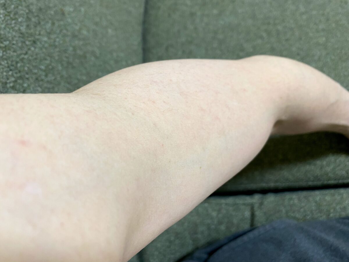 男の全身脱毛1回目2カ月後の腕