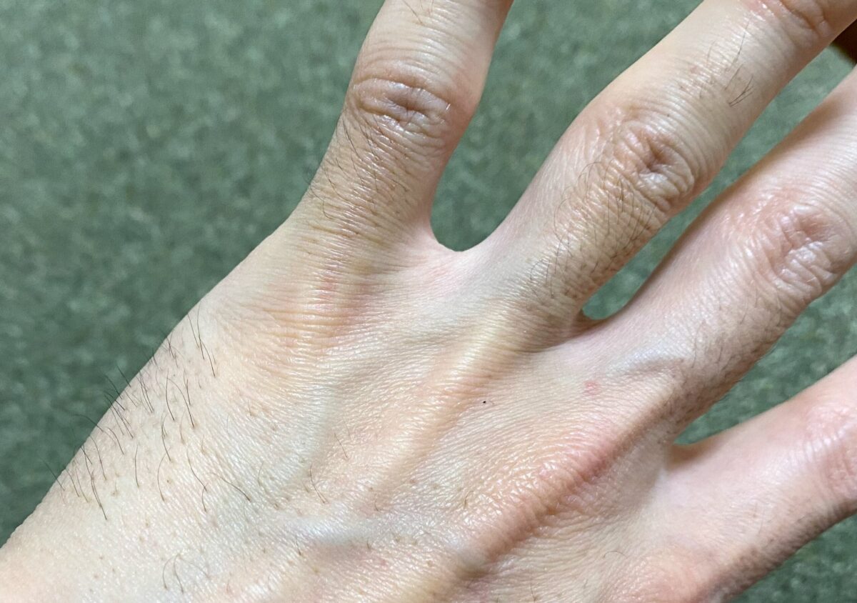 男の全身脱毛1回目2カ月後の腕