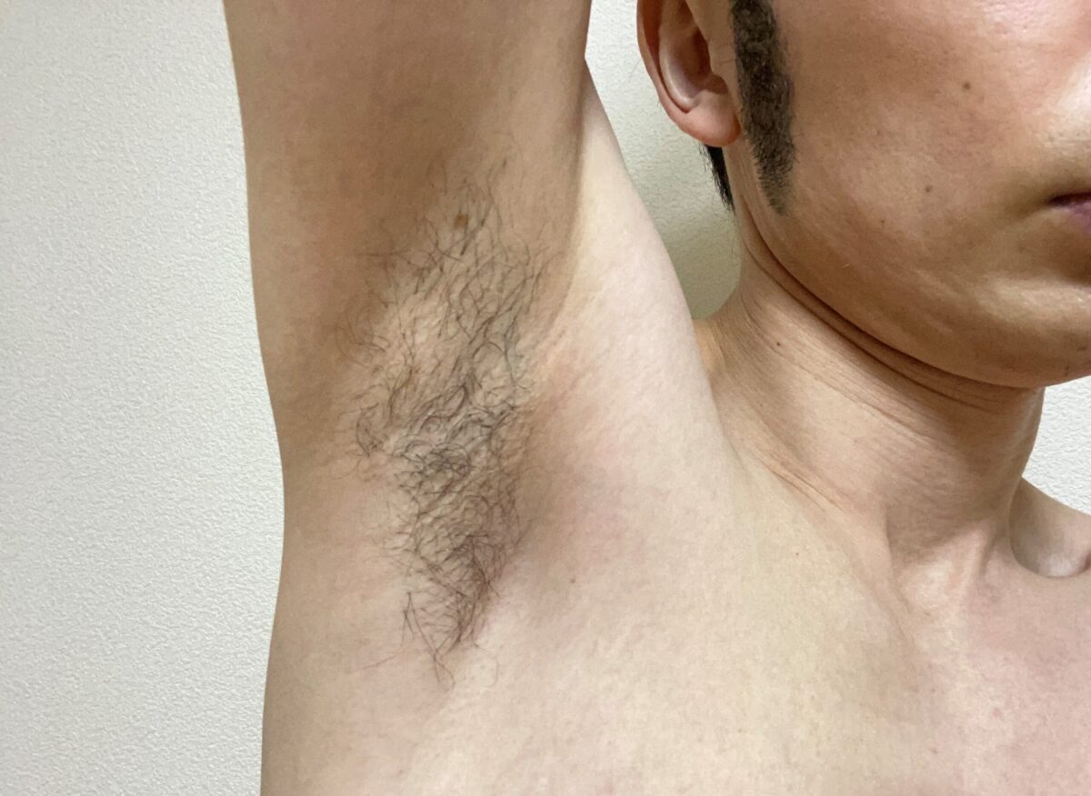 メンズわき脱毛の感想