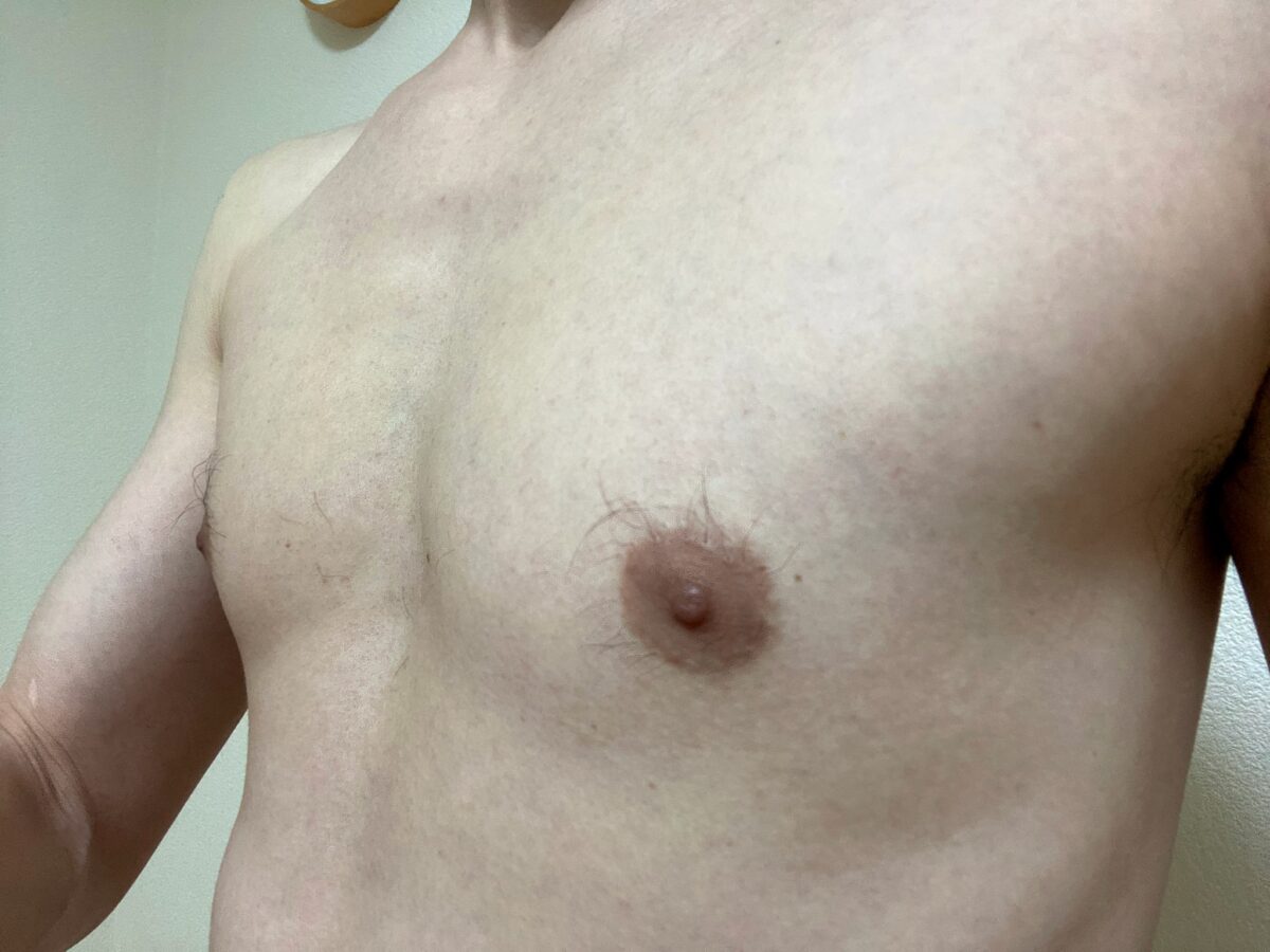 男の全身脱毛1回目の効果