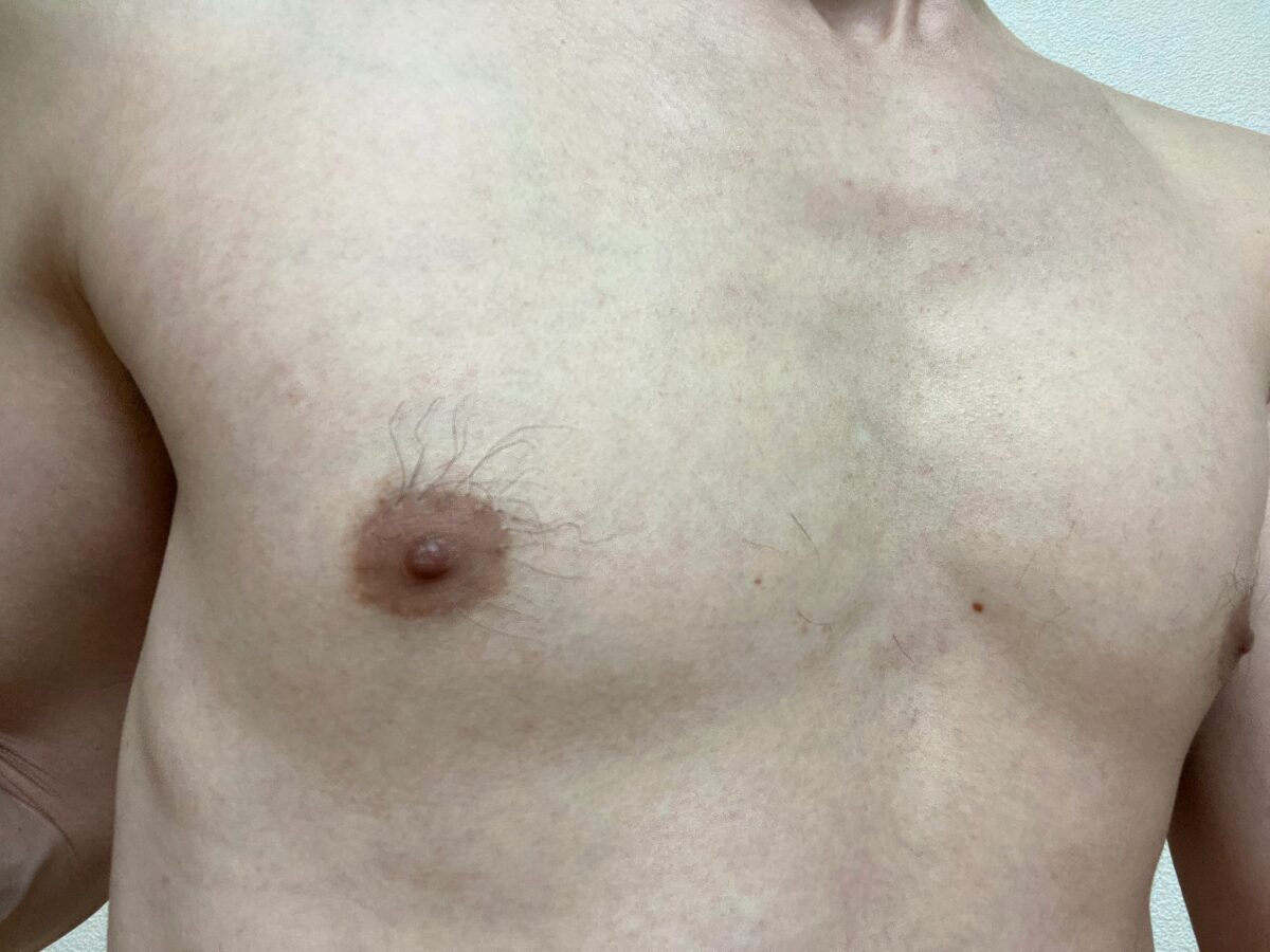 男の全身脱毛1回目の効果